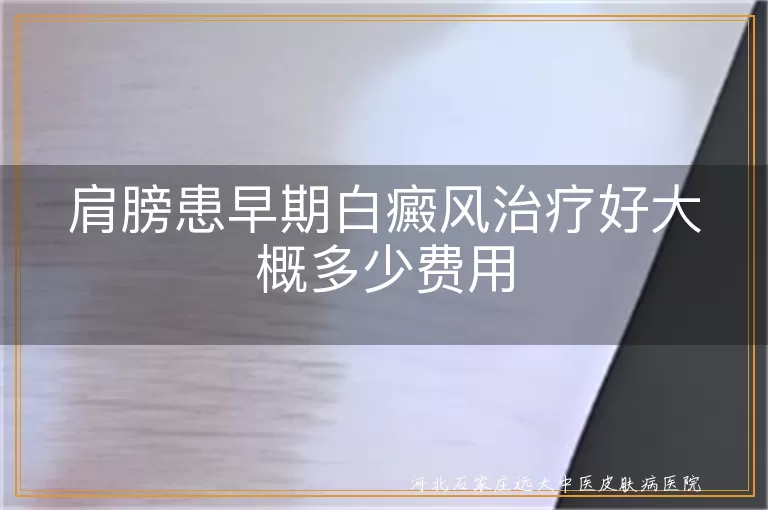 肩膀患早期白癜风治疗好大概多少费用