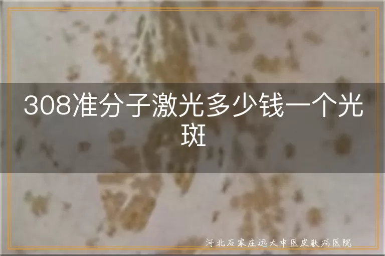 308准分子激光多少钱一个光斑