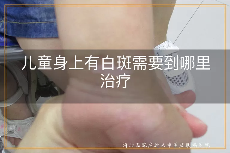 儿童身上有白斑需要到哪里治疗