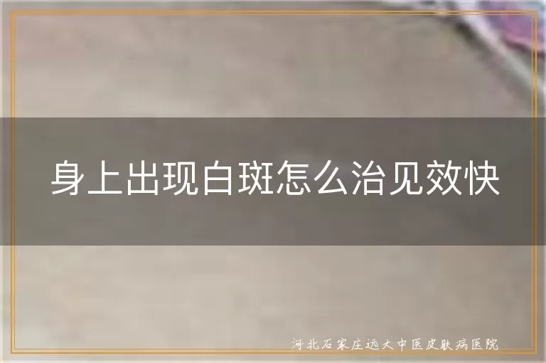 身上出现白斑怎么治见效快