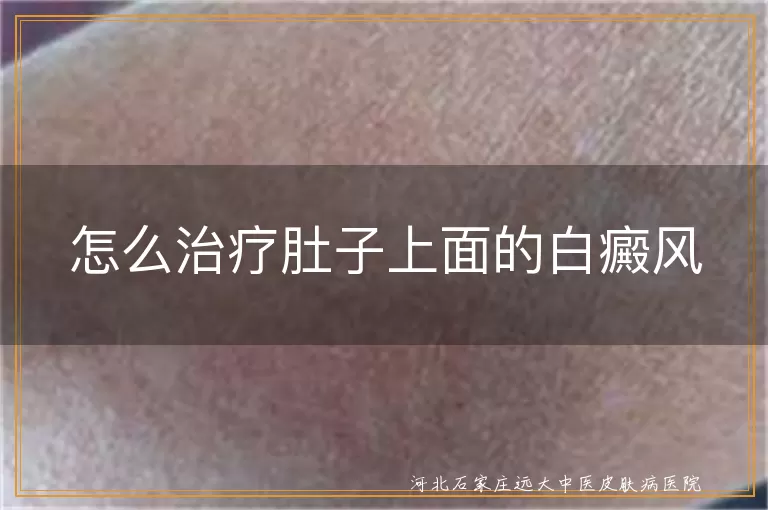 怎么治疗肚子上面的白癜风