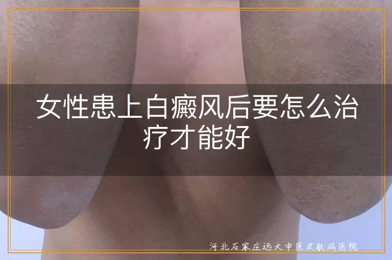 女性患上白癜风后要怎么治疗才能好