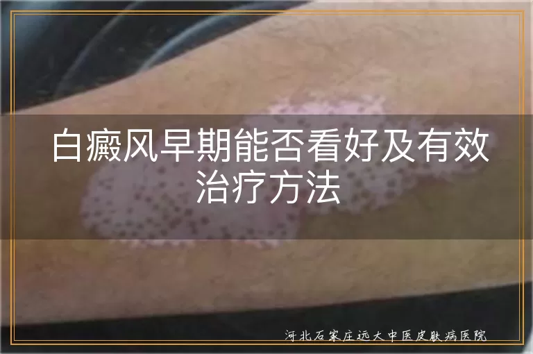 白癜风早期能否看好及有效治疗方法