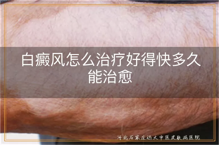 白癜风怎么治疗好得快多久能治愈