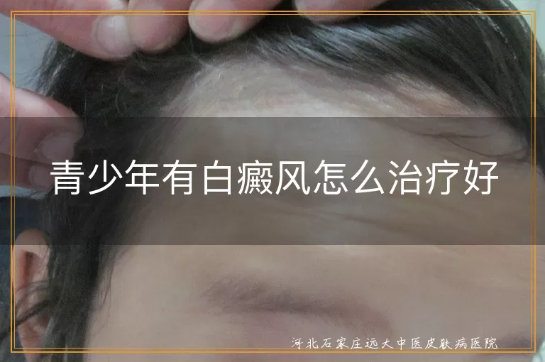 青少年有白癜风怎么治疗好