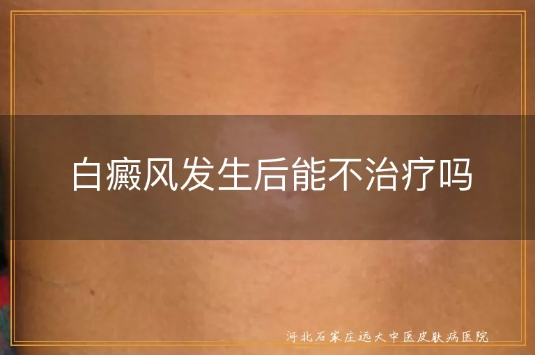 白癜风发生后能不治疗吗