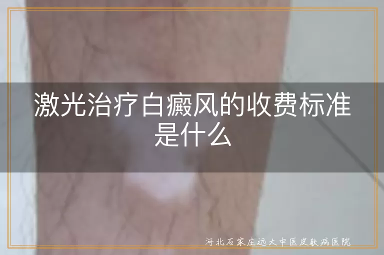 激光治疗白癜风的收费标准是什么