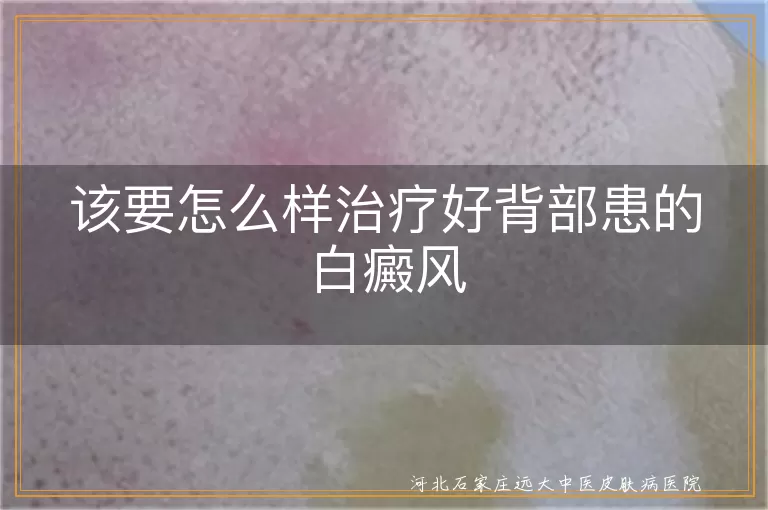 背部白斑治疗指南,白癜风个性化方案,背部白癜风护理要点