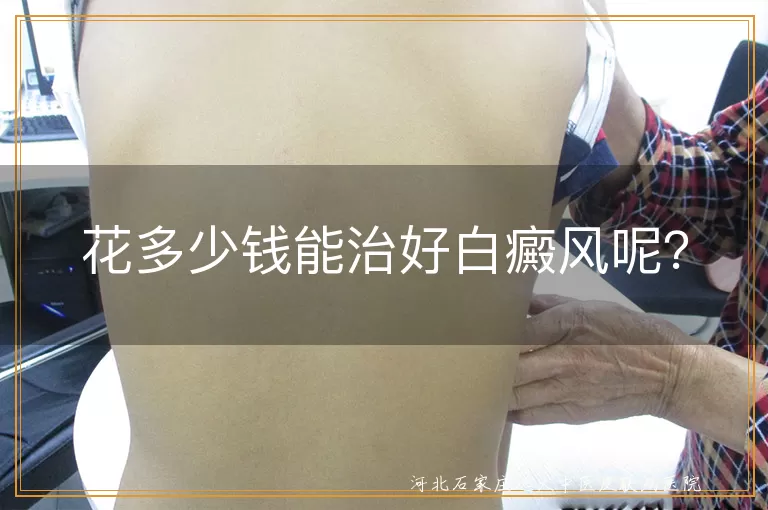 白癜风治疗费用真相揭秘,白斑康复预算参考,治白癜风大概花销