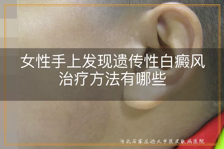 女性手上发现遗传性白癜风治疗方法有哪些
