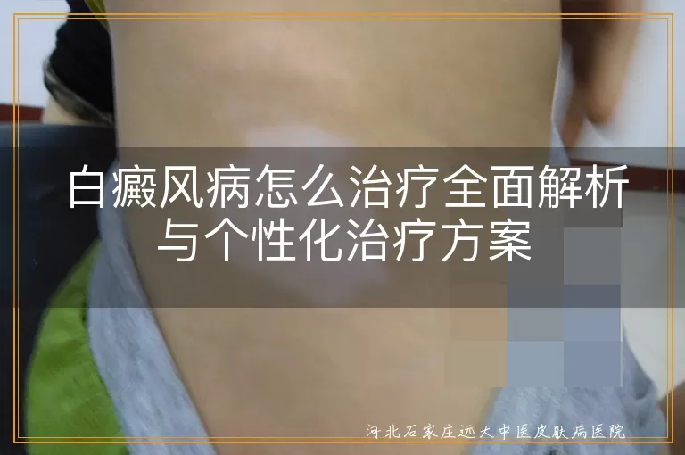 白癜风分期治疗全攻略,白斑个性化干预新思路,白癜风中西结合康复方案