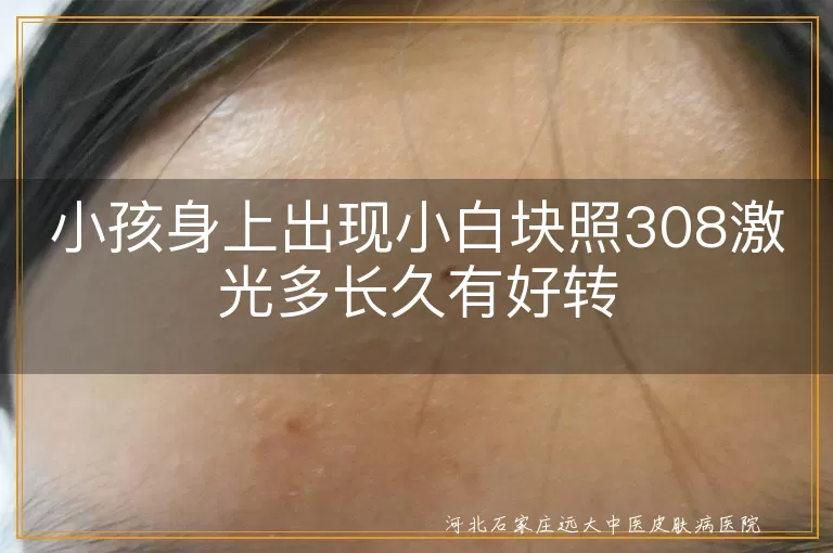 儿童白斑308激光见效周期,白癜风早期干预多久恢复,小孩白癜风308光疗好转时间