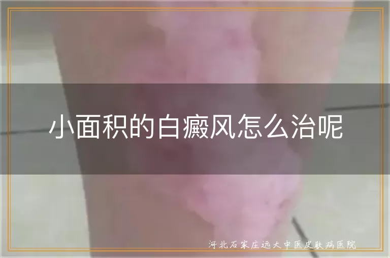小面积的白癜风怎么治呢