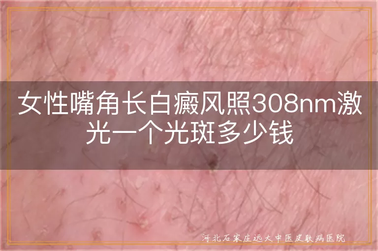 女性嘴角长白癜风照308nm激光一个光斑多少钱