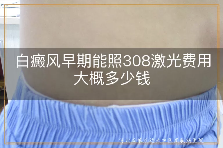 白癜风早期能照308激光费用大概多少钱