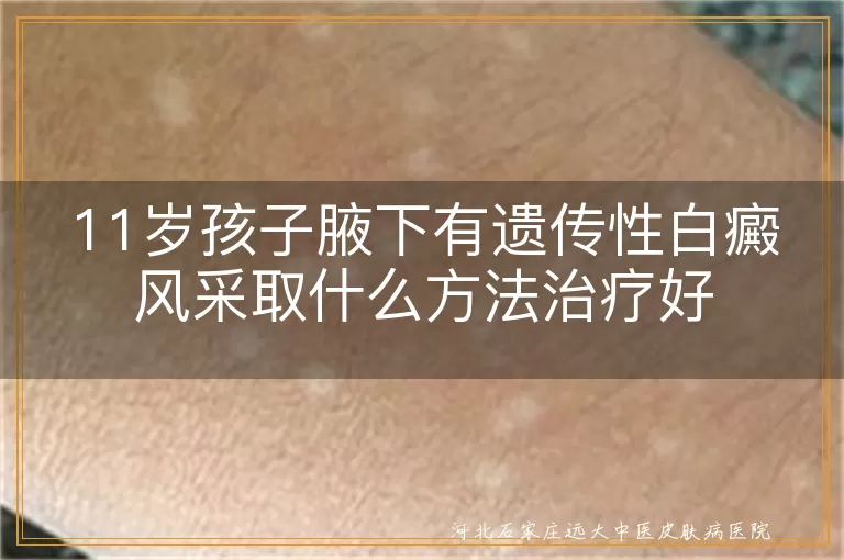 遗传性白斑儿童怎么治,青春期腋下白癜风护理妙招,小朋友白斑家长如何配合