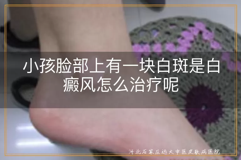 儿童面部白癜风应对策略,小孩白斑初期诊治方案,脸上白癜风康复路线图
