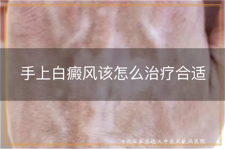 手部白癜风治疗方法,手掌白斑康复要点,白癜风手部护理策略
