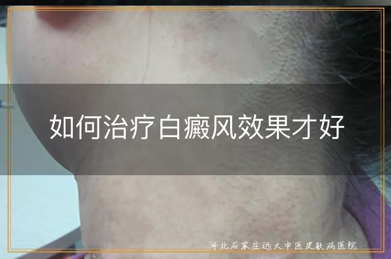 白癜风康复新方法,白斑全面阻断方案,白癜风患者日常调理技巧