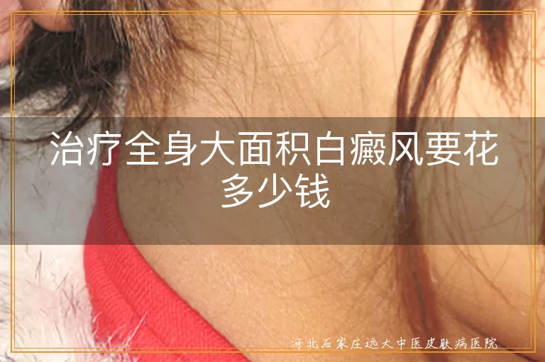 全身白斑治疗价格,大面积白癜风费用估算,白癜风治疗成本
