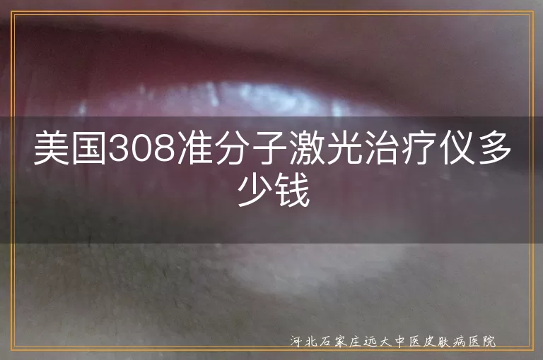 美国白癜风治疗仪价格揭秘,白斑308激光费用参考,308准分子光疗仪多少钱白癜风