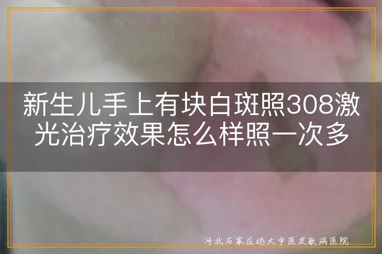 新生儿手部白斑308激光效果,婴儿白癜风308光疗一次时长,宝宝白斑308准分子光频率