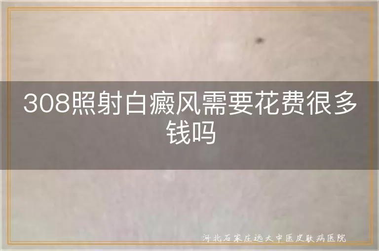 白癜风308光疗花费高吗,白斑308激光一次贵不贵,308照射白癜风价格真相