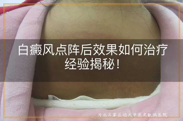 白癜风点阵后护理要点,白斑点阵激光恢复经验,白癜风激光术后效果提升