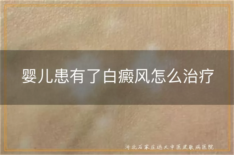 婴幼儿白斑怎样处理,婴儿白癜风早期干预,宝宝皮肤白斑应对