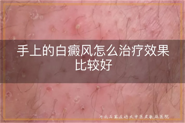 手上的白癜风怎么治疗效果比较好