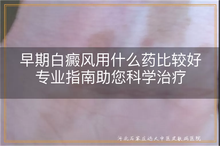 早期白癜风用什么药比较好专业指南助您科学治疗