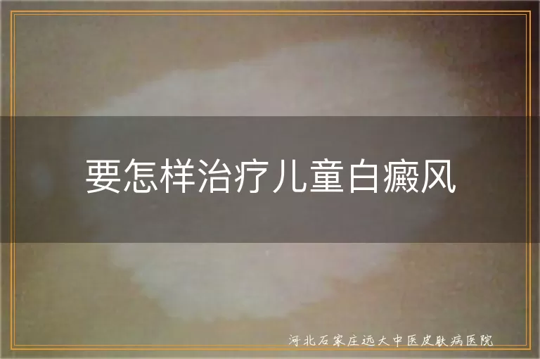 要怎样治疗儿童白癜风