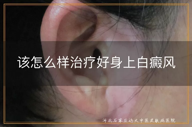 白癜风科学治疗攻略,白斑个性化复色方案,白癜风日常防扩散技巧