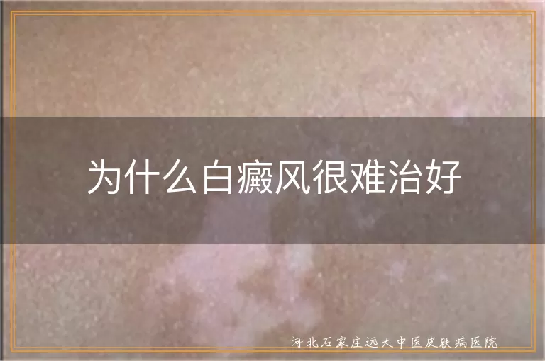 白癜风反复发作原因揭秘,白斑为何久治不愈,白癜风难治根源解析