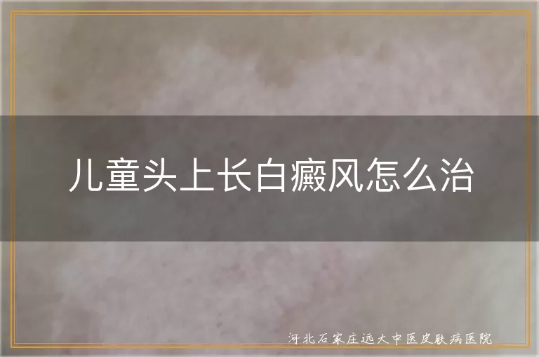 儿童头皮白斑治疗方案,儿童白癜风早期干预,儿童头部白斑护理要点