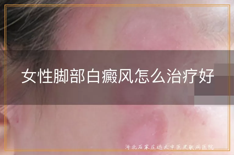 女性脚部白癜风如何治疗好,女性脚部白斑治疗注意事项,女性脚部白癜风康复方法