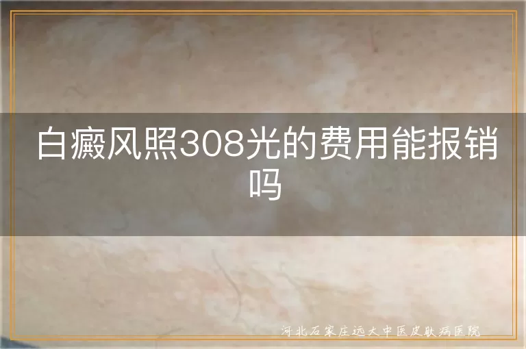 白癜风308光疗能否医保报销,白斑照308激光费用能报吗,白癜风激光治疗费用报销情况
