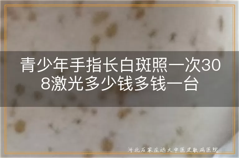 青少年手指白癜风308激光单次价格,白斑照308激光费用一台机器,手指白癜风308激光治疗多少钱