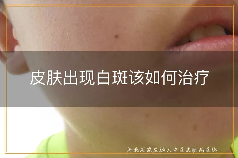 皮肤出现白斑该如何治疗