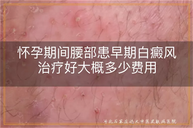 孕期腰部早期白斑治疗,孕期白癜风费用参考,孕早期白斑控制花费