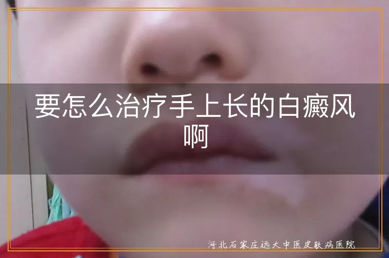 要怎么治疗手上长的白癜风啊