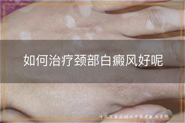 如何治疗颈部白癜风好呢