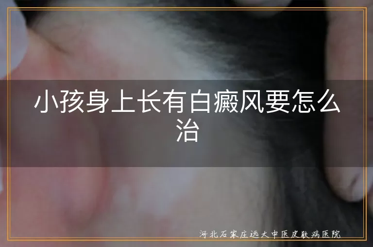 小孩身上长有白癜风要怎么治