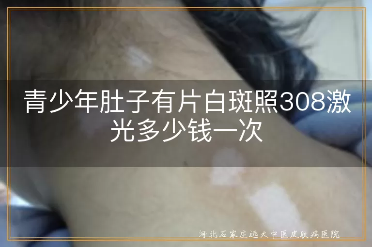 青少年肚子有片白斑照308激光多少钱一次