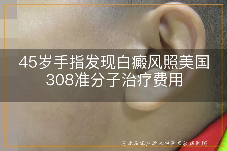 45岁手指发现白癜风照美国308准分子治疗费用