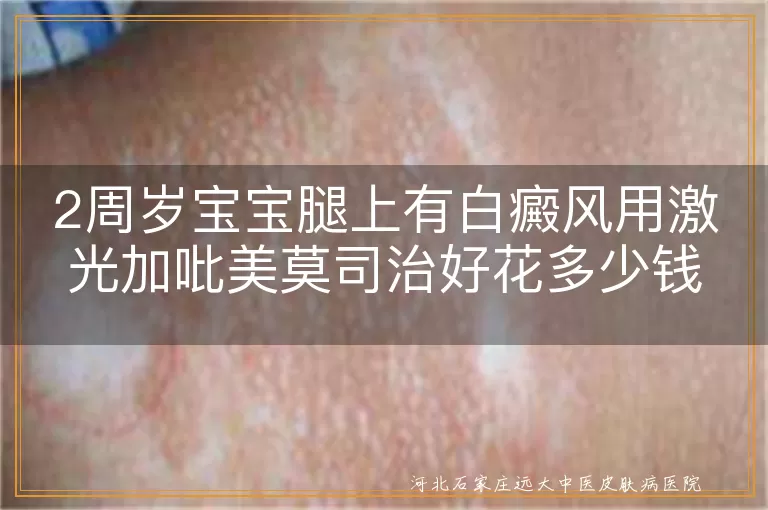 两岁幼儿腿部白斑激光联合吡美莫司治疗要准备多少钱,宝宝腿白癜风激光加外用钙调磷酸酶抑制剂大概花费,幼儿白斑照光配吡美莫司治好得花多少钱