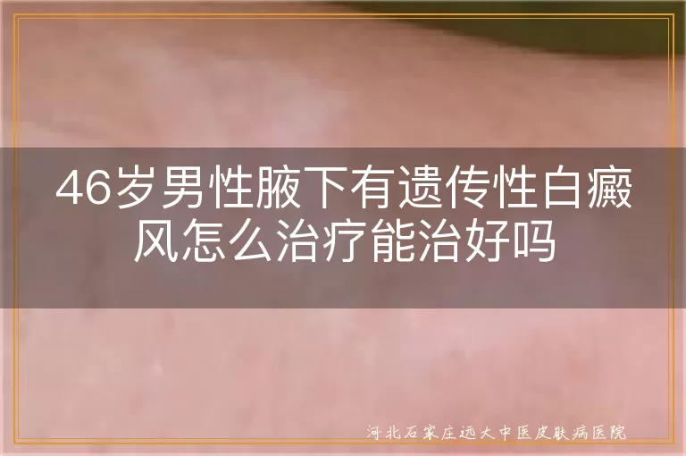 46岁男性腋下有遗传性白癜风怎么治疗能治好吗