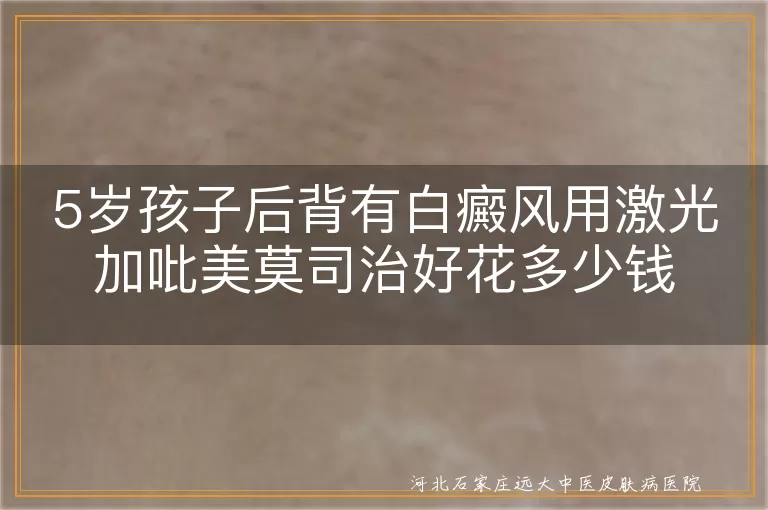 5岁后背白斑照光药费大概,儿童后背白癜风激光吡美莫司花费,后背白癜风激光联合吡美莫司治多少钱