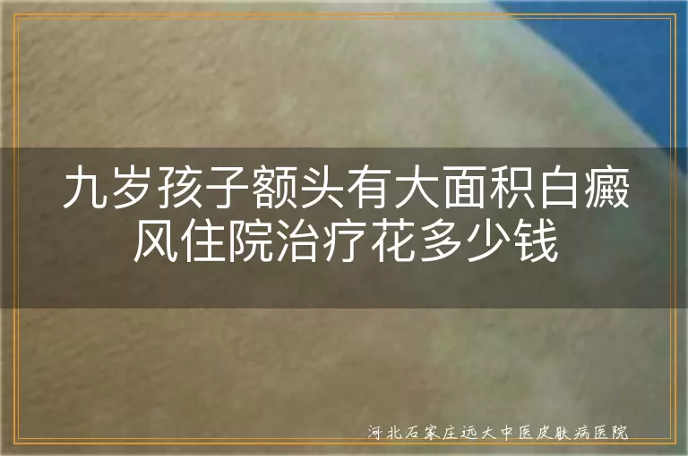 九岁孩子额头白斑住院花费,儿童白癜风大面积治疗费用,小朋友白癜风住院花多少钱