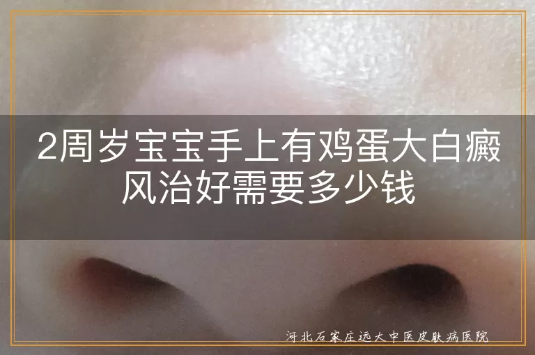 2周岁宝宝手上有鸡蛋大白癜风治好需要多少钱